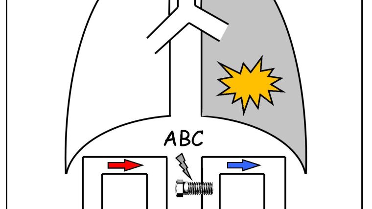 Cartoon of pair of lungs displaying how Almitrine Bismesylate operates in Covid-19. Arrows underneath show blood flow is blocked from entering diseased right hand lung.
