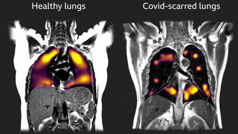 Scarred lungs compared with healthy lungs show much larger areas of darkness, representing parts of the lungs that are having difficulty transporting oxygen into the blood stream.