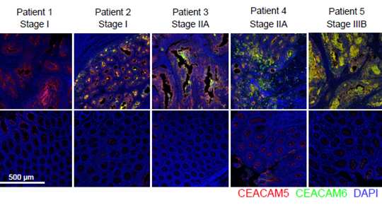 CEACAM6 is expressed in late-stage human colorectal tumour tissues. Representative images of CEACAM5 (red), CEACAM6 (green), and DAPI (blue) fluorescence in matched pairs of human normal colon and tumour formalin-fixed paraffin-embedded (FFPE) tissue sections from colorectal cancer patients.