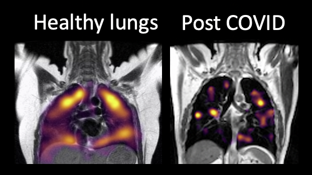 The healthy lungs appear to have more gas activity present than the post Covid scan which shows more dark areas indicating damage.